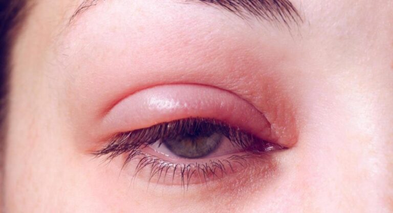 Eye Flu : डोळे आल्यावर अँण्टीबायोटिक ड्रॉप्स वापरणे फायदेशीर आहे का ? वाचा नेत्रतज्ज्ञ काय सांगतात
