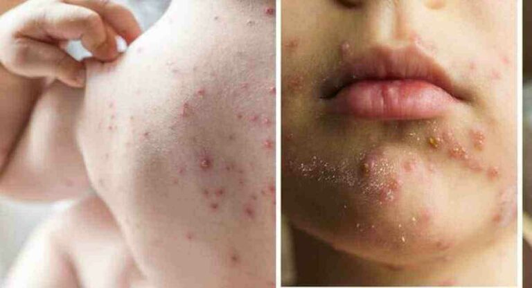 Chickenpox : कांजण्यांचा नवा व्हेरिएंट लहान मुलांना करतोय टार्गेट